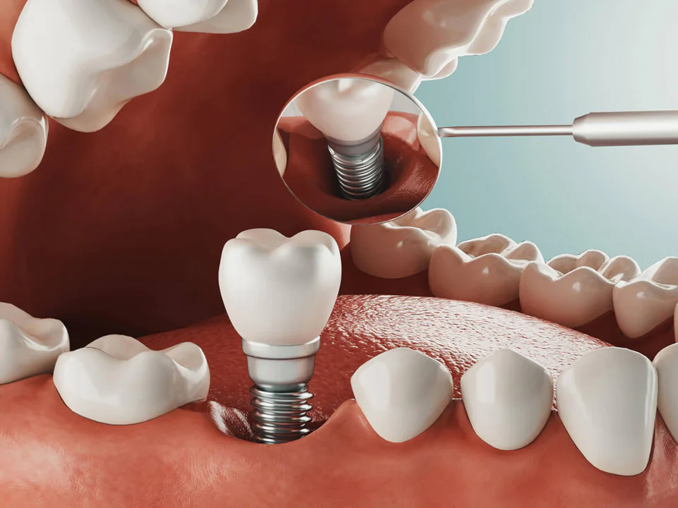 Dental Implants in Redmond, OR at Pacific Family Dental