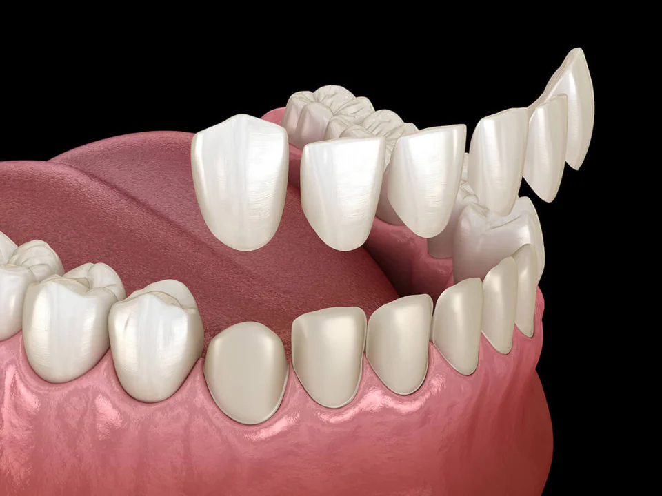 Dental Veneers in Redmond, OR at Pacific Family Dental