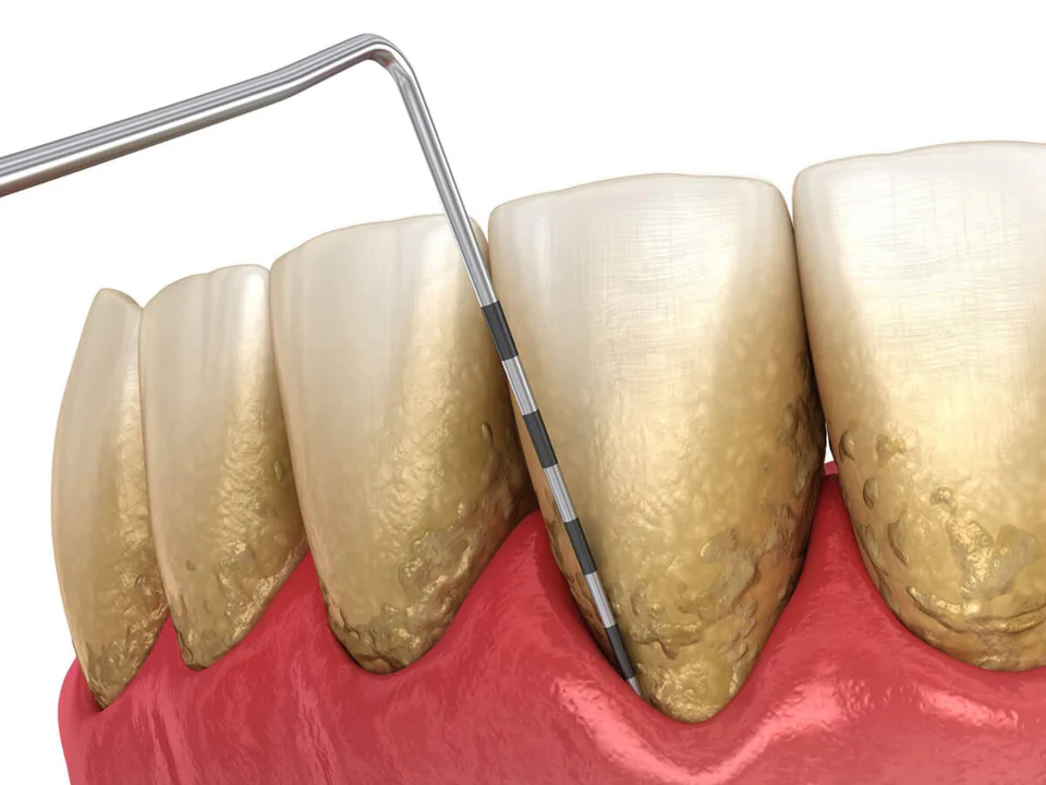 Gum Disease Treatment in Redmond, OR at Pacific Family Dental
